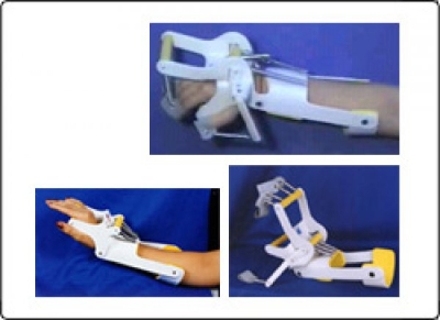 Dynamic Radial Palsy Splint