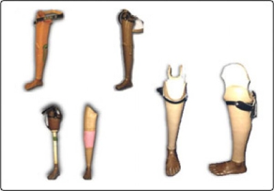 Jaipur Above-knee Prosthesis